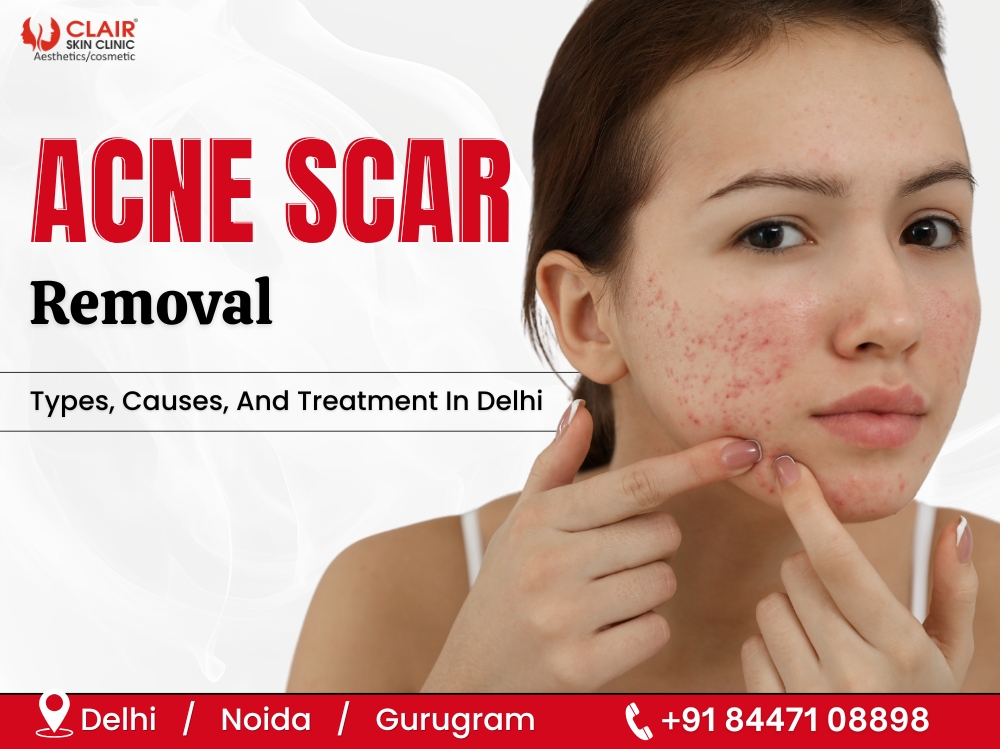 Acne Scar Removal Types, Causes, And Treatment In Delhi