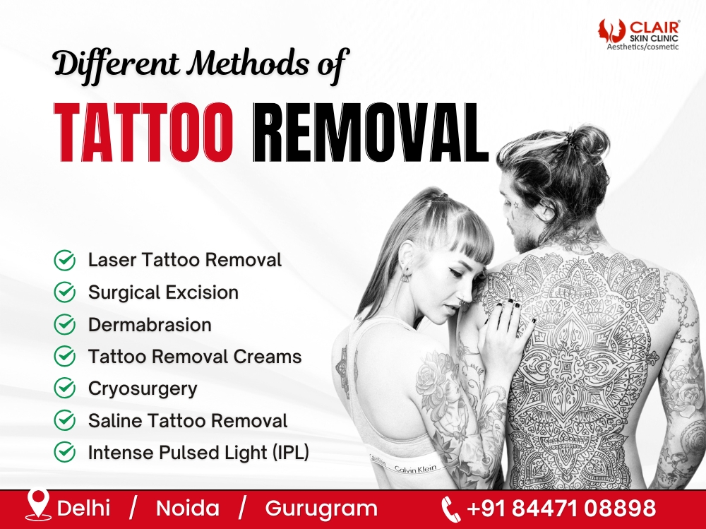 Different Methods of Tattoo Removal