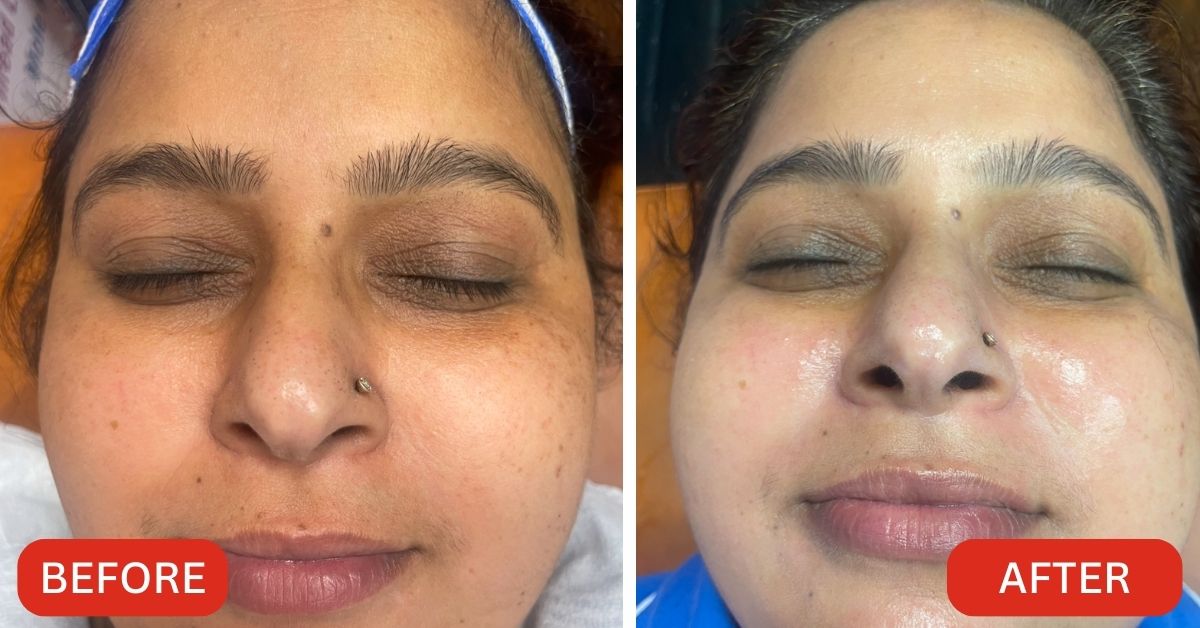 HydraFacial-5-min.jpg