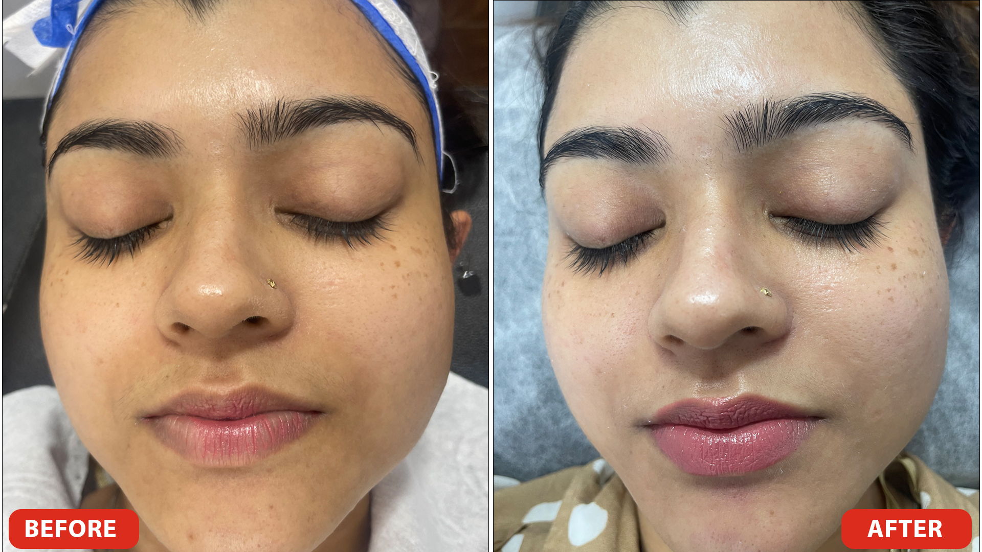 HydraFacial-Before-After-copy1.jpg