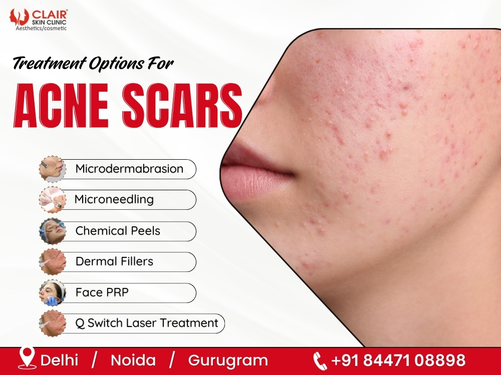 Treatment Options For Acne Scars