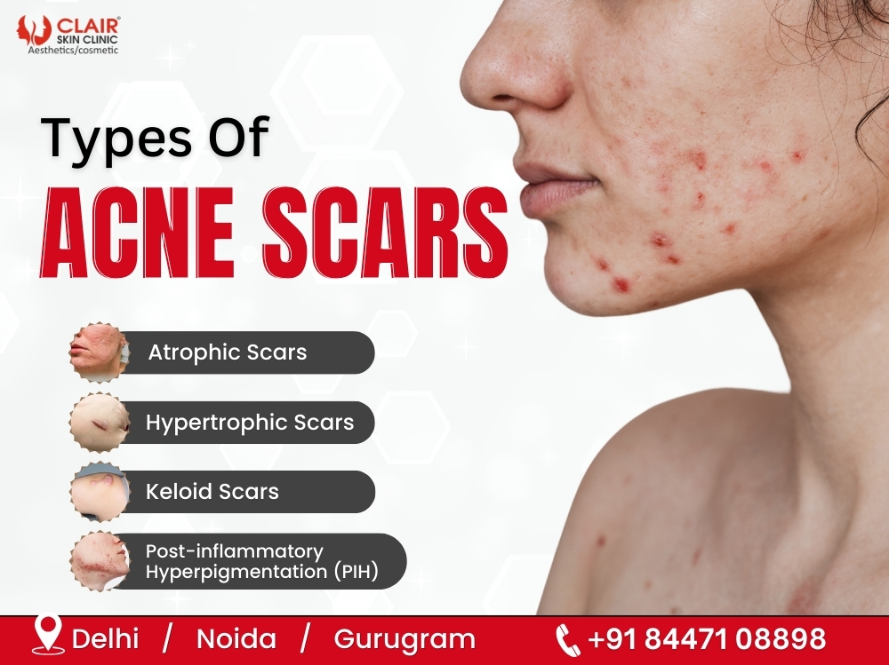 Types Of Acne Scars