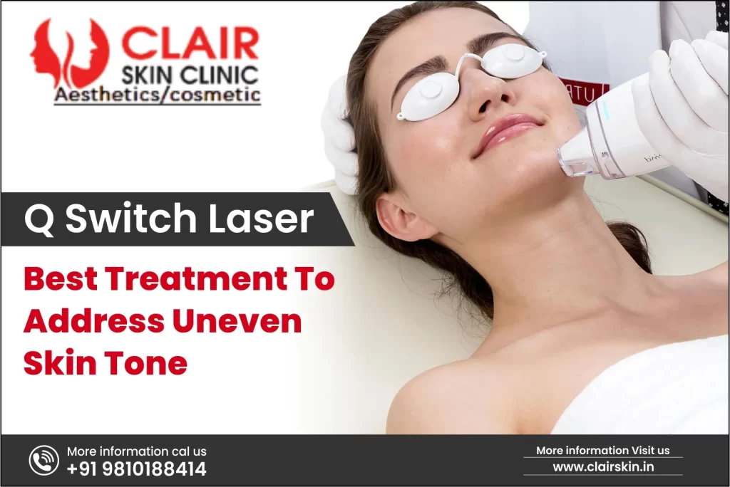 Q Switch Laser treatment