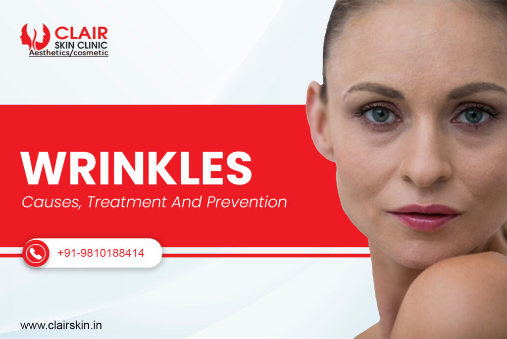 Wrinkles: Causes, Treatment and Prevention