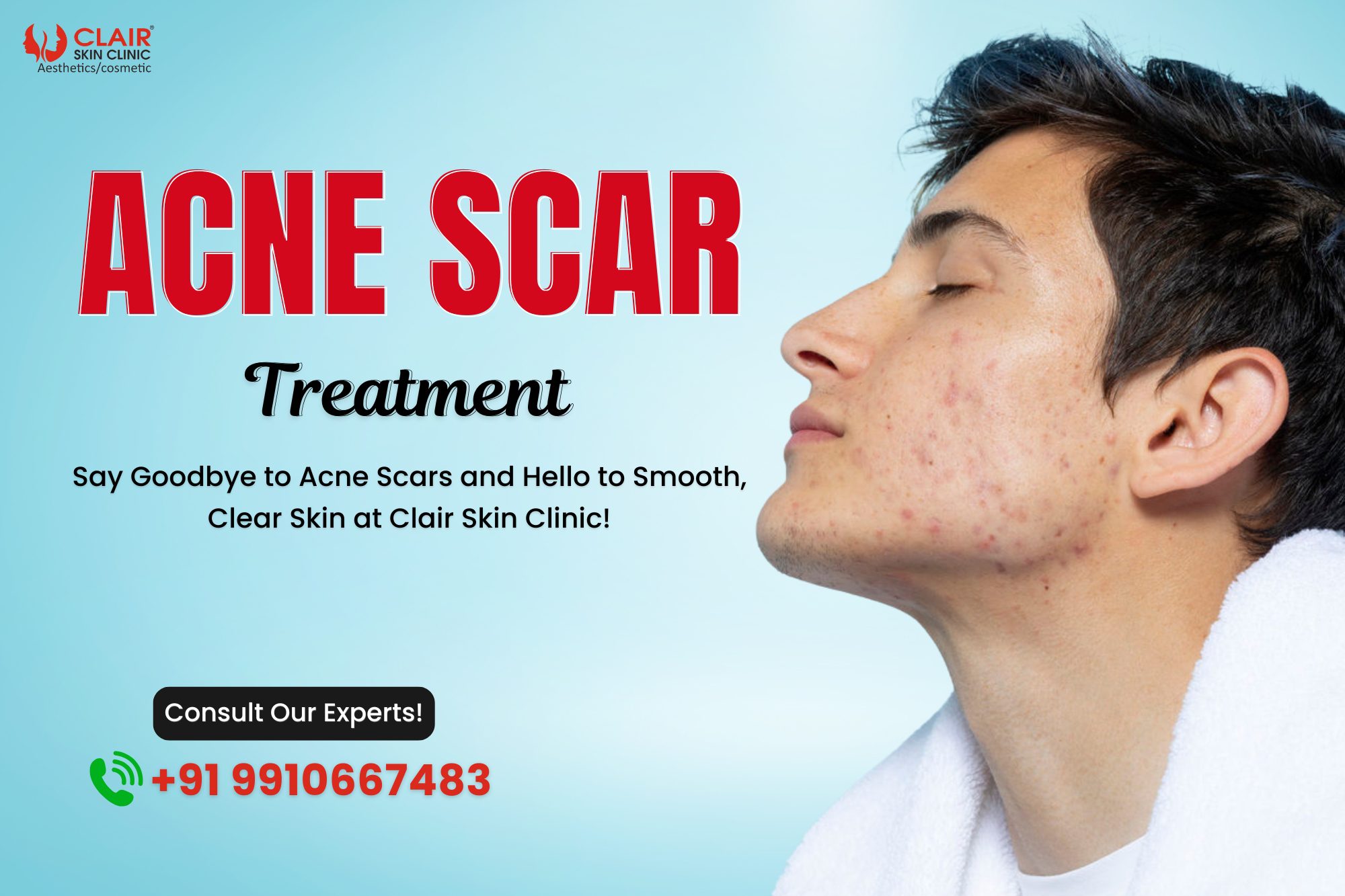 Acne Scar Treatment