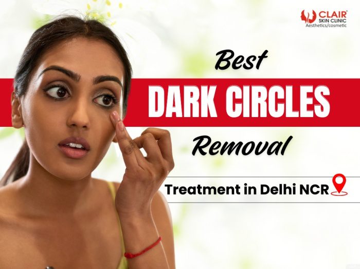 Best Dark Circles Removal Treatment in Delhi NCR