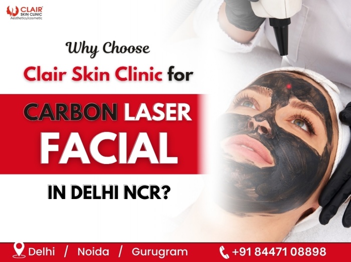 Carbon Laser Facial Treatment in Delhi NCR