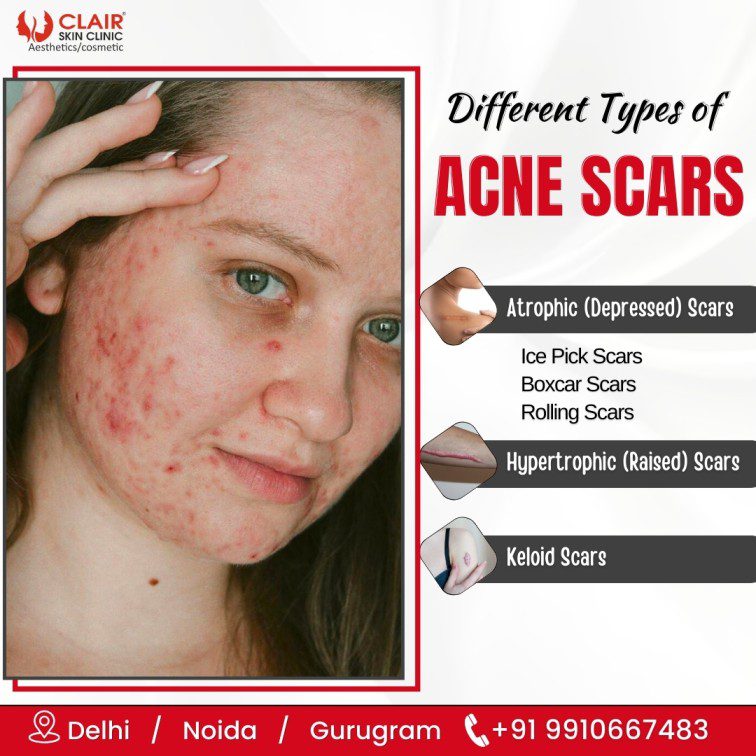 Different Types of Acne Scars