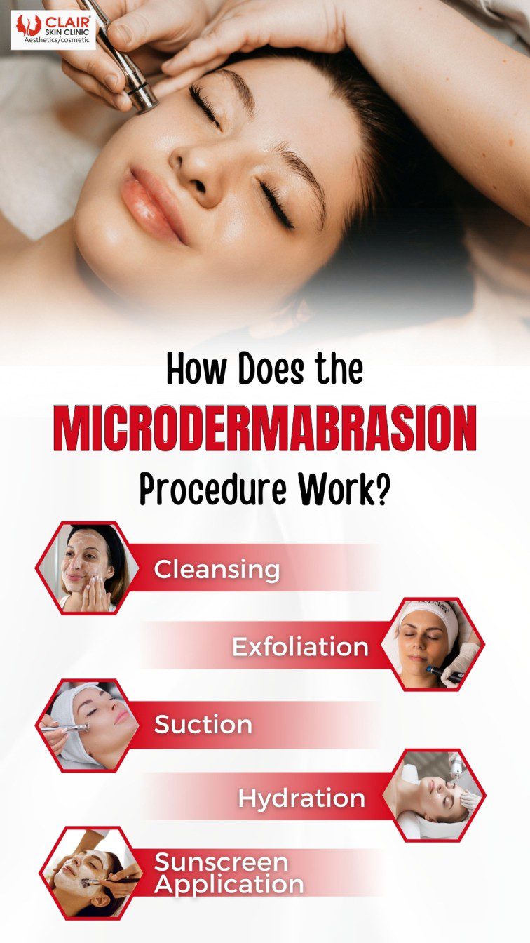 How Does the Microdermabrasion Procedure Work