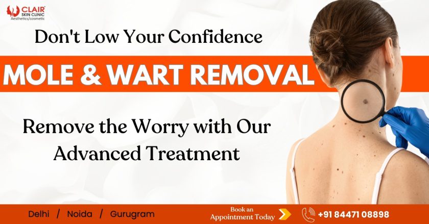 Mole & Wart Removal Treatment in Delhi NCR