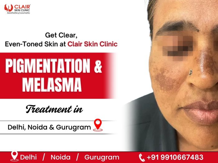 Pigmentation & Melasma Treatment in delhi ncr