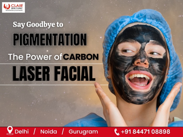 Say Goodbye to Pigmentation The Power of Carbon Laser Facial