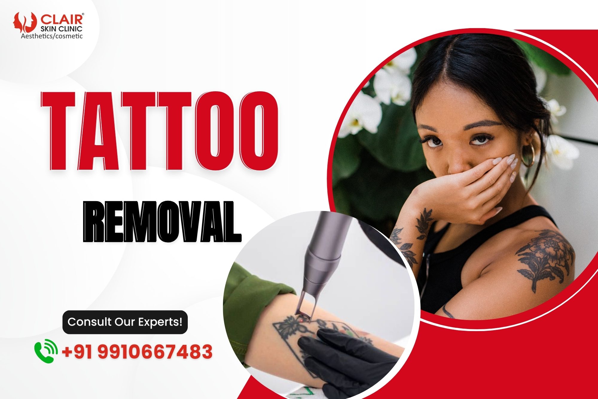 Tattoo Removal Treatment