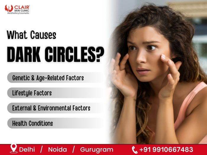 What Causes Dark Circles