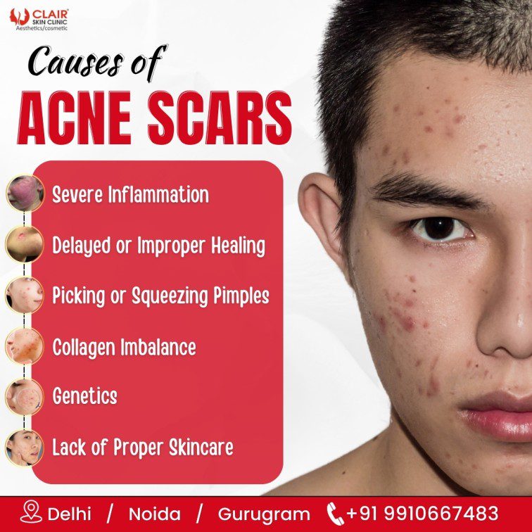 causes of acne scars