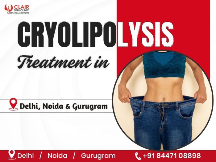 Cryolipolysis Treatment in Delhi