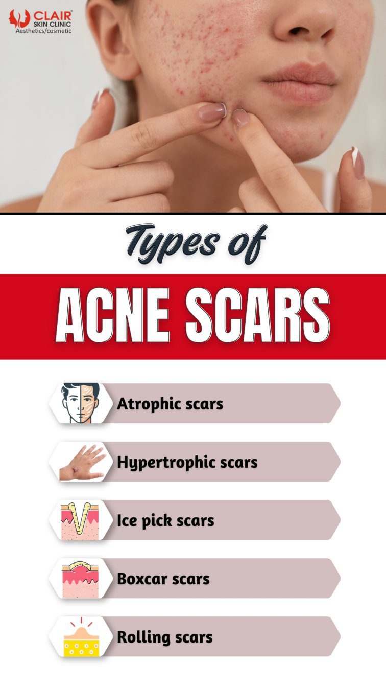 Types of Acne Scars