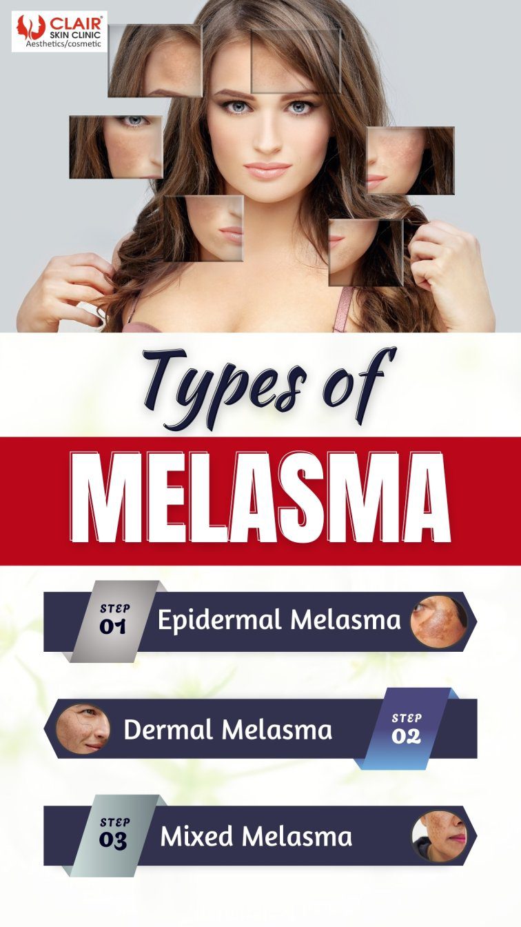 Types of Melasma